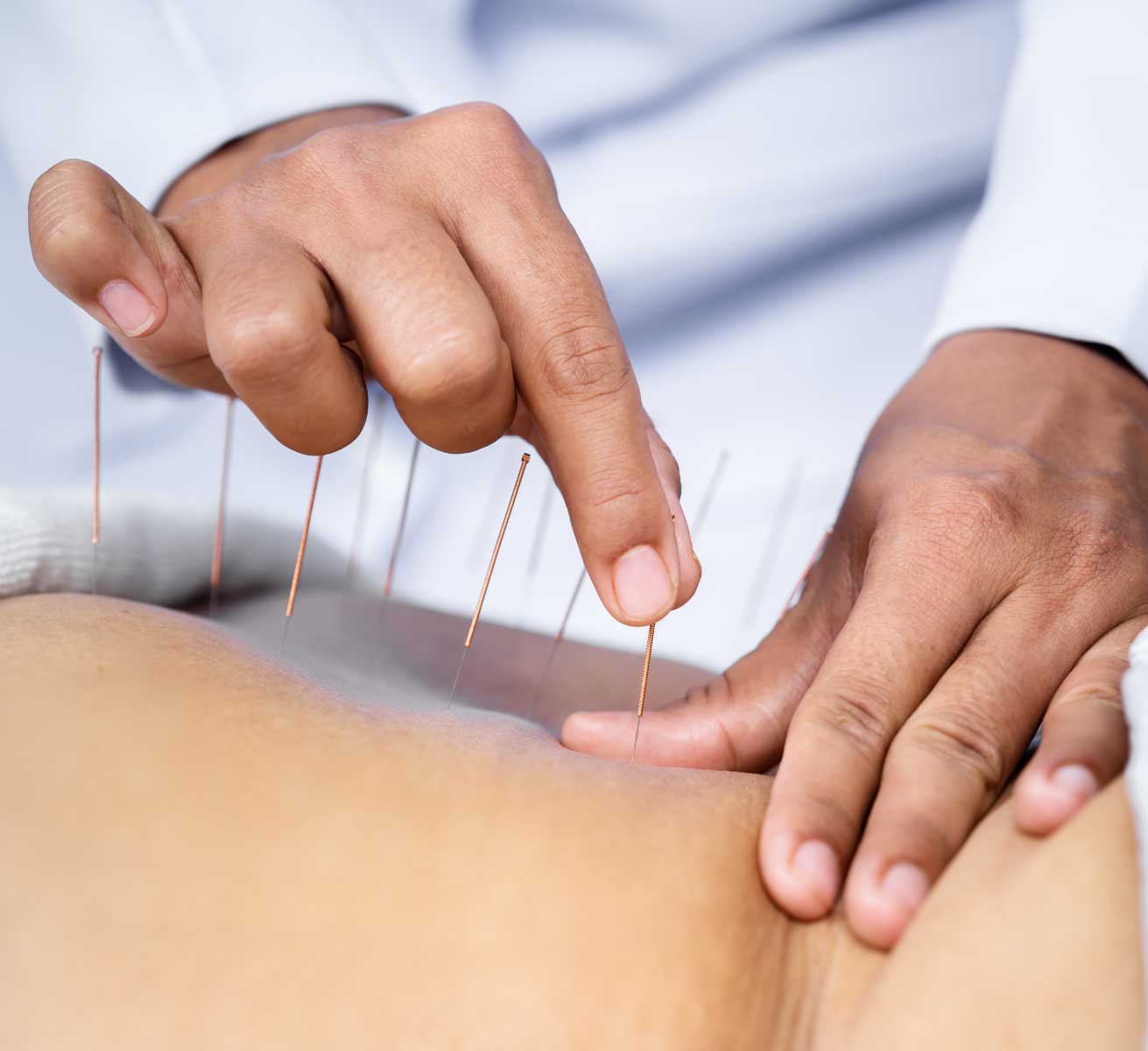 Akupunktur