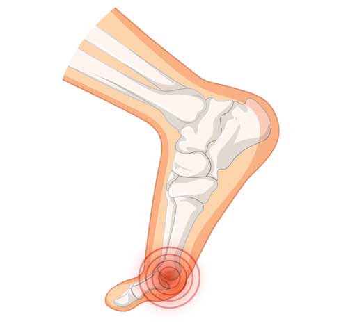 Fußschmerzen