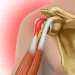 Trochanter-Bursitis