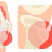 Osgood-Schlatter-Krankheit