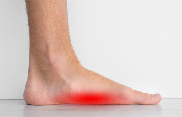 Plattfuß (Pes Planus): Ursachen, Symptome und Behandlung